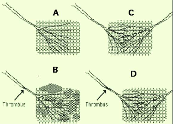 obstruction arterielle